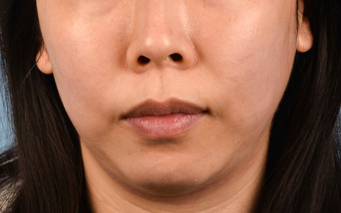 Ultherapy Before & After Gallery - Patient 134425 - Image 1