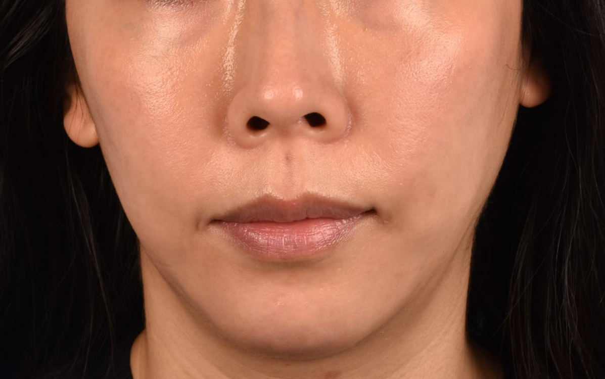 Ultherapy Before & After Gallery - Patient 134425 - Image 2