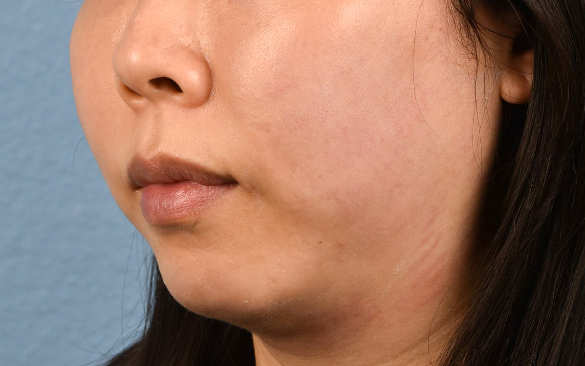 Ultherapy Before & After Gallery - Patient 134425 - Image 3