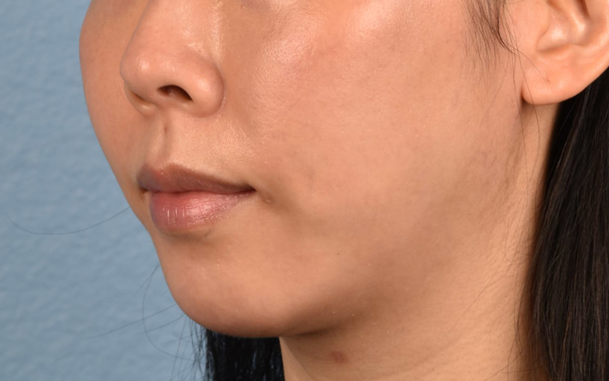 Ultherapy Before & After Gallery - Patient 134425 - Image 4