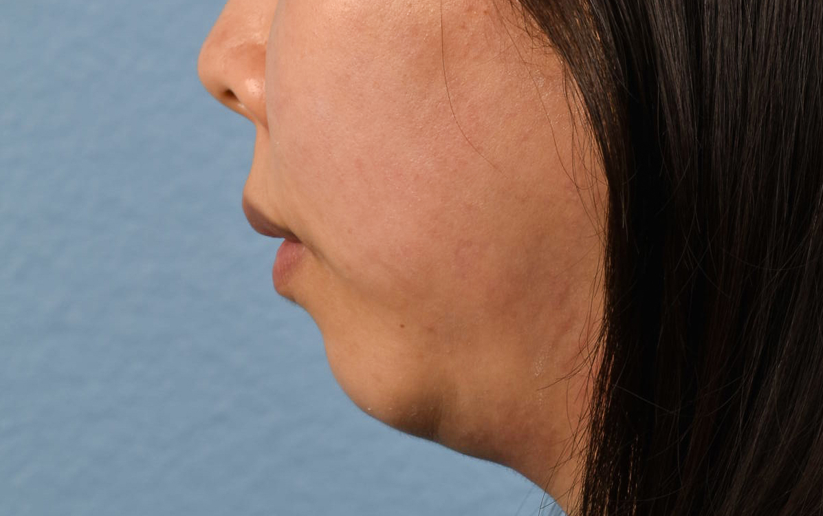 Ultherapy Before & After Gallery - Patient 134425 - Image 5