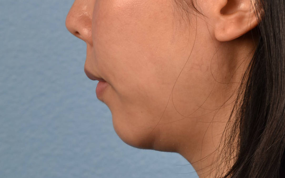 Ultherapy Before & After Gallery - Patient 134425 - Image 6
