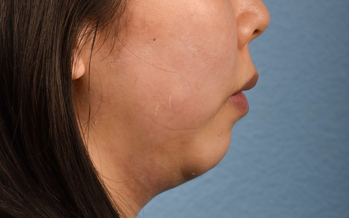 Ultherapy Before & After Gallery - Patient 134425 - Image 7