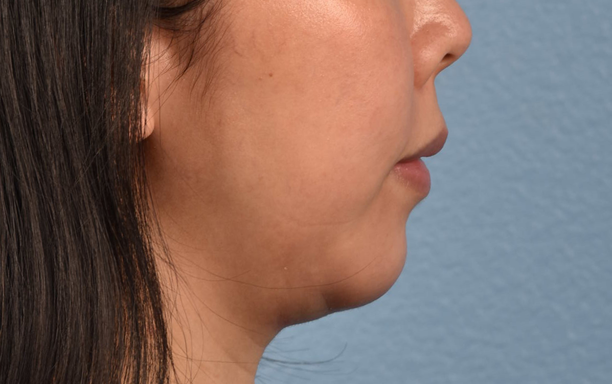 Ultherapy Before & After Gallery - Patient 134425 - Image 8