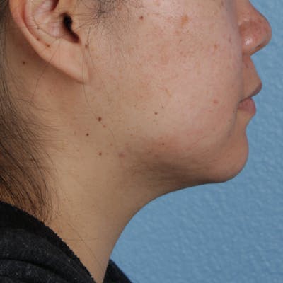 Renuvion Before & After Gallery - Patient 296884 - Image 1