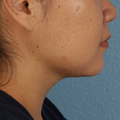 Renuvion Before & After Gallery - Patient 296884 - Image 2