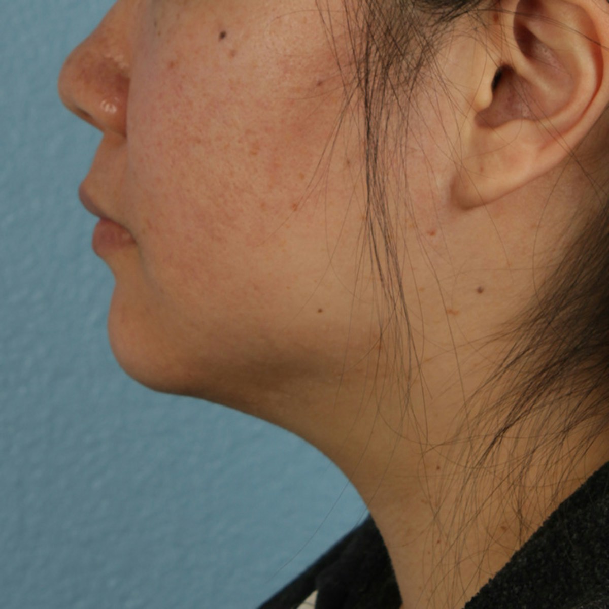 Renuvion Before & After Gallery - Patient 296884 - Image 3