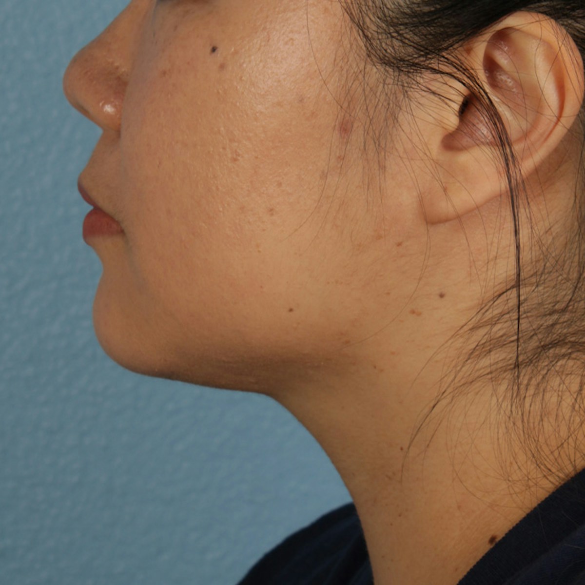 Renuvion Before & After Gallery - Patient 296884 - Image 4