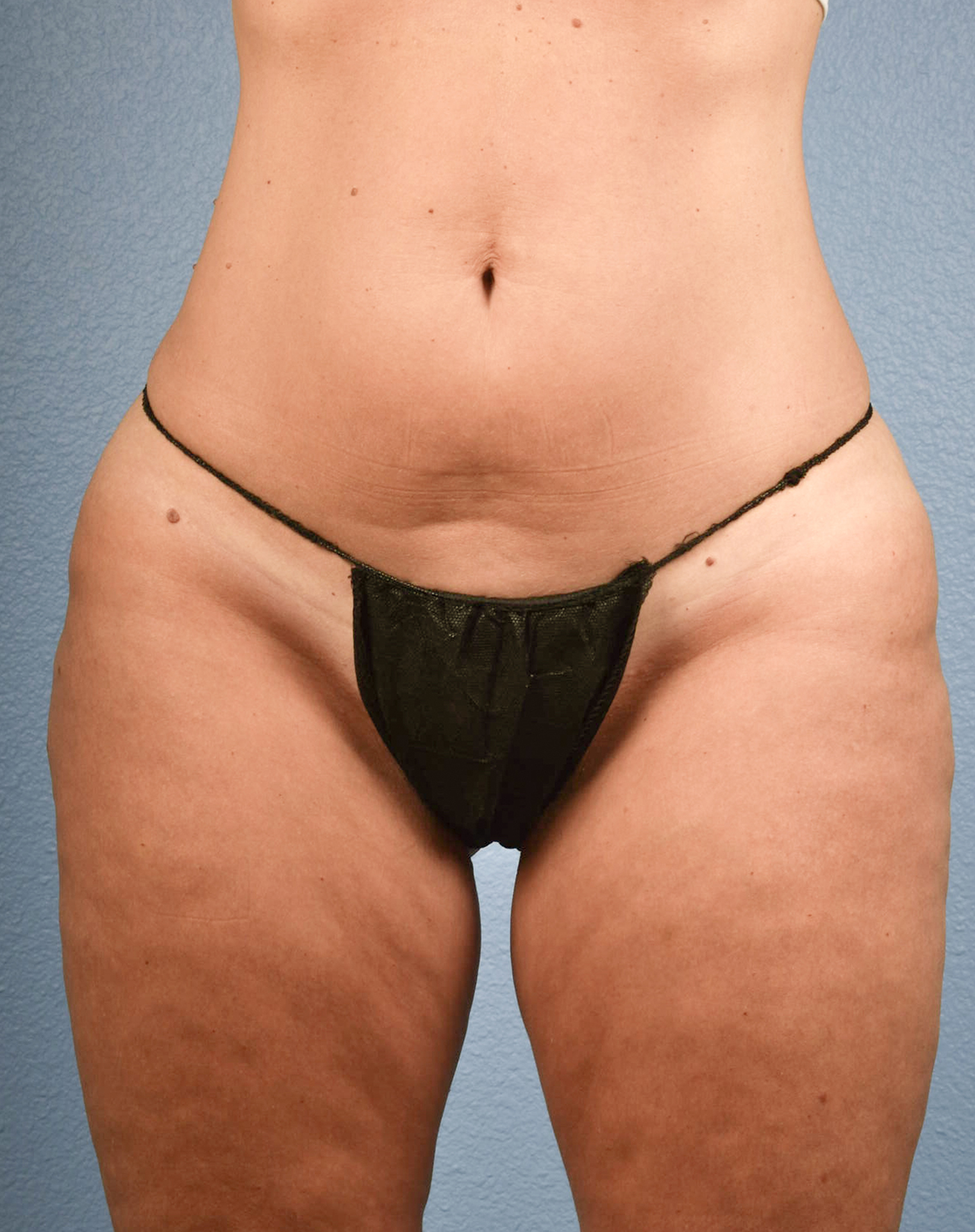 CoolSculpting Before & After Gallery - Patient 100667 - Image 1
