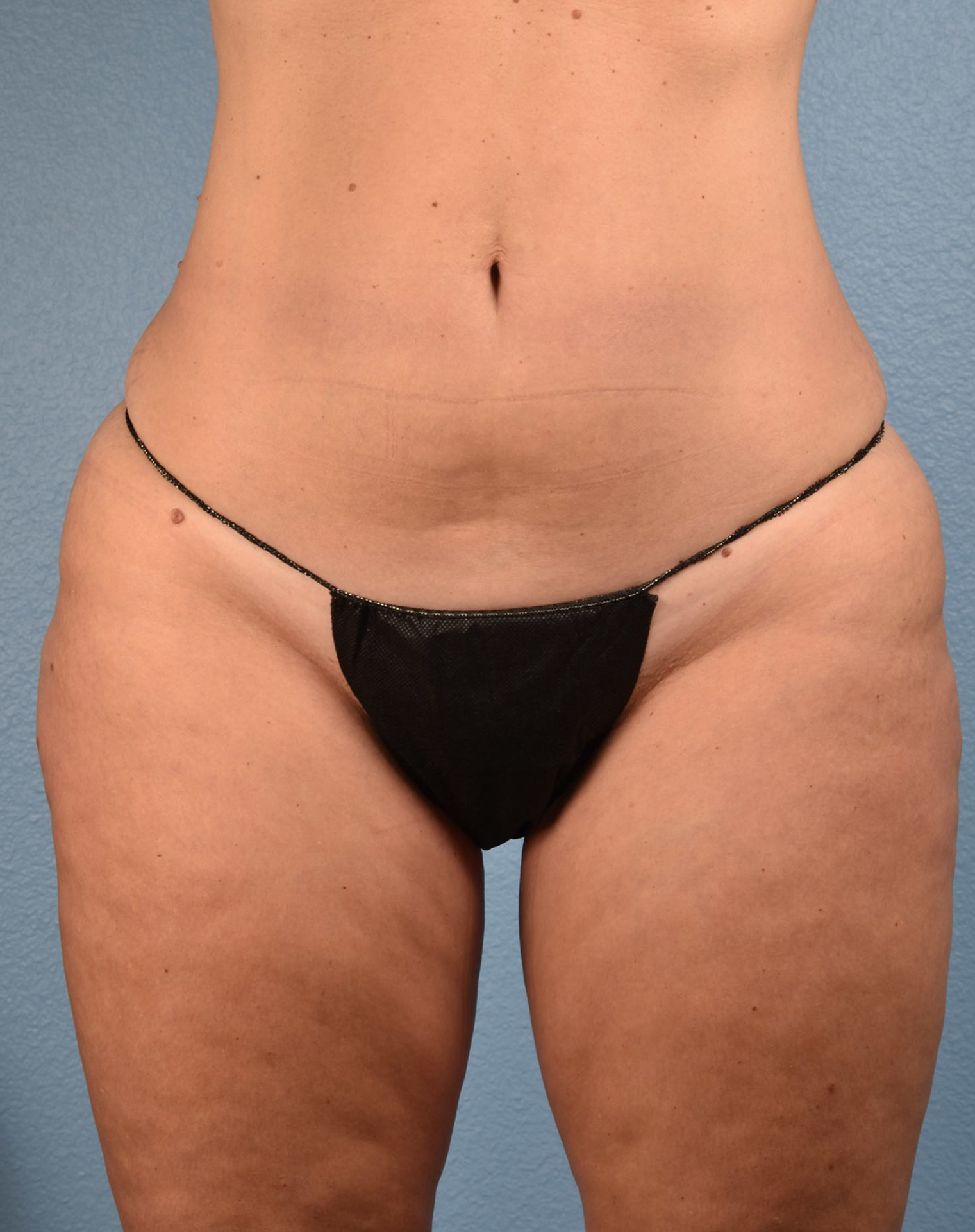 CoolSculpting Before & After Gallery - Patient 100667 - Image 2