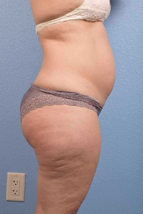 CoolSculpting Before & After Gallery - Patient 168019 - Image 1
