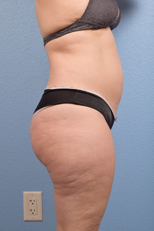 CoolSculpting Before & After Gallery - Patient 168019 - Image 2