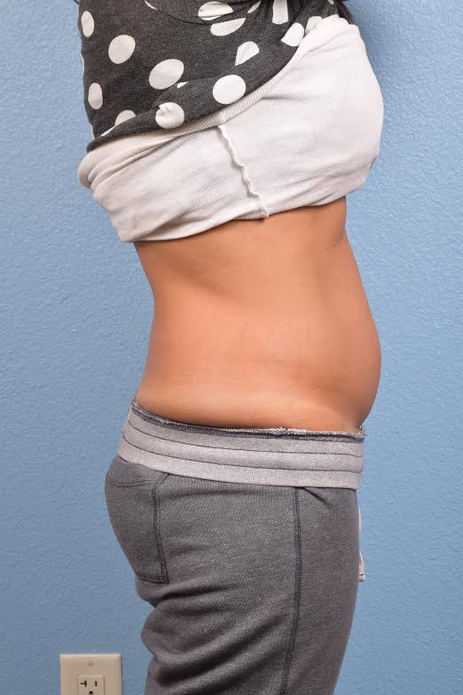 CoolSculpting Before & After Gallery - Patient 156566 - Image 1
