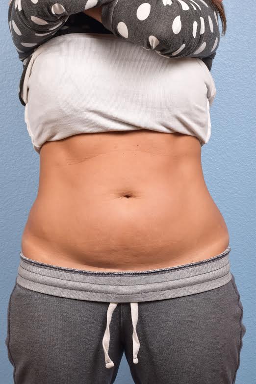 CoolSculpting Before & After Gallery - Patient 156566 - Image 3