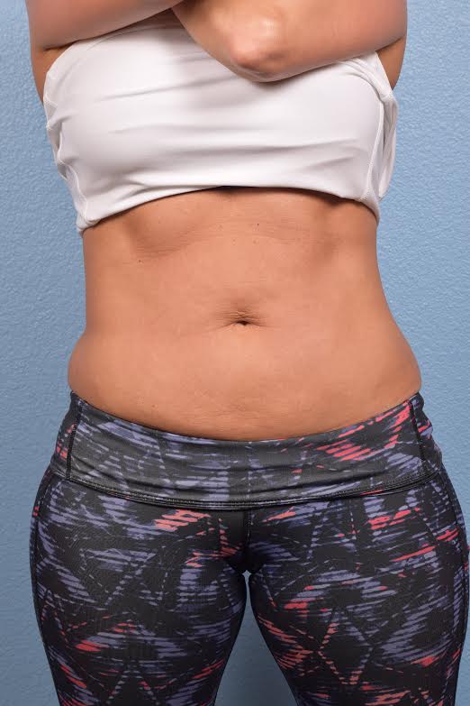 CoolSculpting Before & After Gallery - Patient 156566 - Image 4