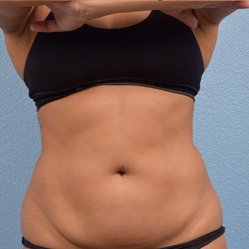 CoolSculpting Before & After Gallery - Patient 388152 - Image 2