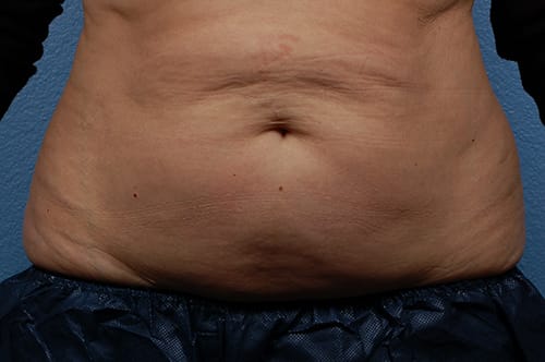 CoolSculpting Before & After Gallery - Patient 290235 - Image 1