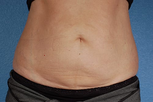CoolSculpting Before & After Gallery - Patient 290235 - Image 2