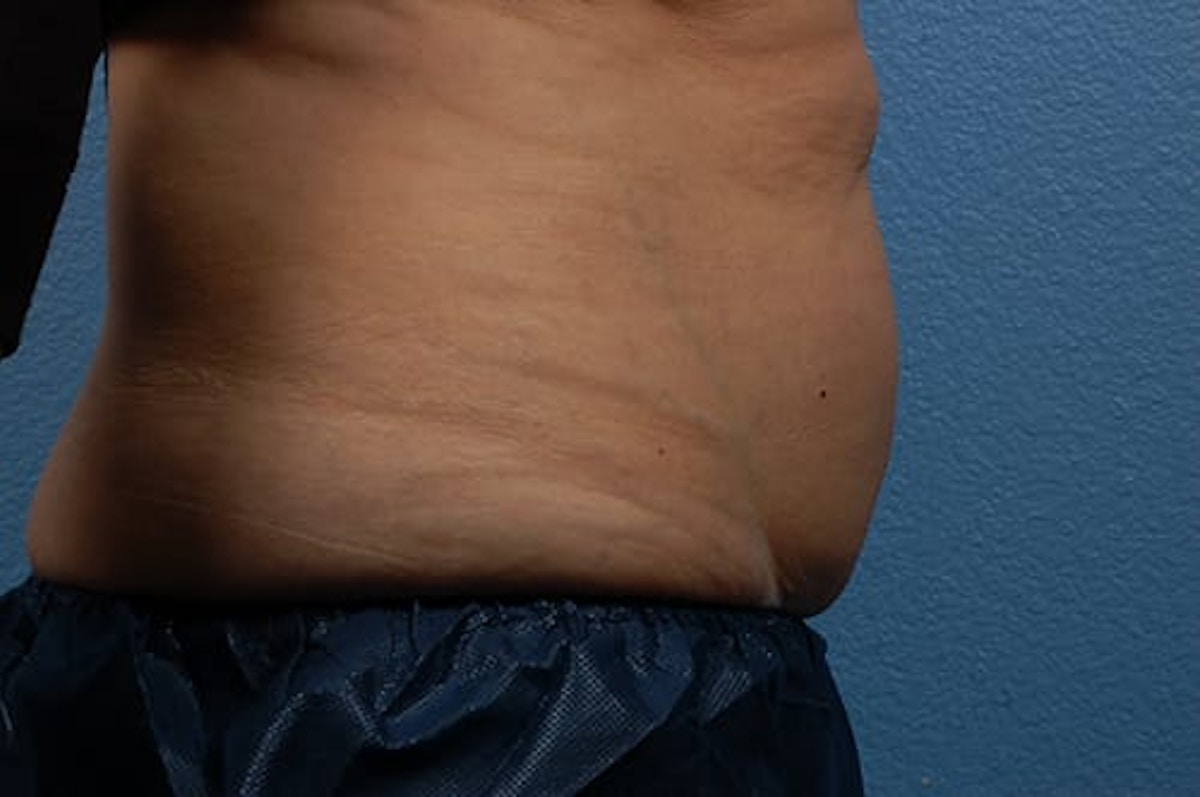 CoolSculpting Before & After Gallery - Patient 290235 - Image 5