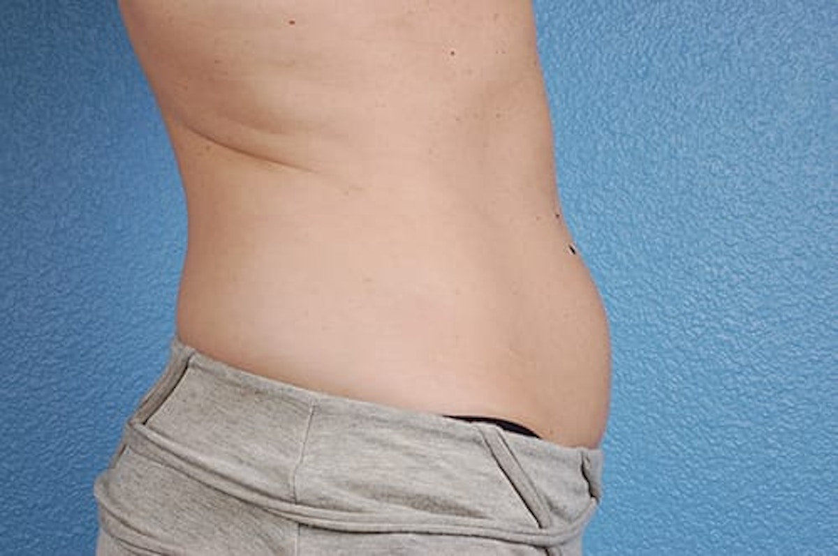 CoolSculpting Before & After Gallery - Patient 184876 - Image 5