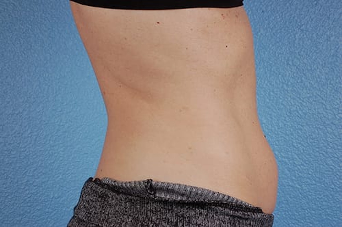 CoolSculpting Before & After Gallery - Patient 184876 - Image 6