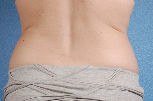 CoolSculpting Before & After Gallery - Patient 184876 - Image 1