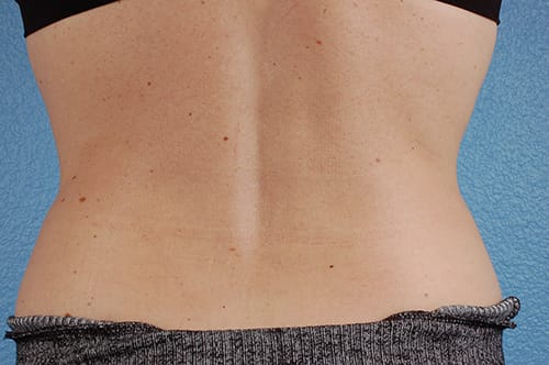 CoolSculpting Before & After Gallery - Patient 184876 - Image 2