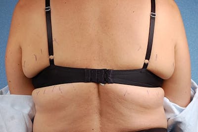 CoolSculpting Before & After Gallery - Patient 132971 - Image 1
