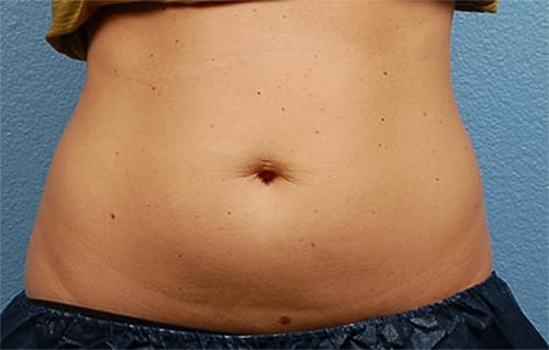 CoolSculpting Before & After Gallery - Patient 126163 - Image 1