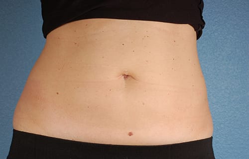 CoolSculpting Before & After Gallery - Patient 126163 - Image 2