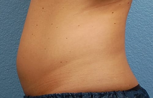 CoolSculpting Before & After Gallery - Patient 126163 - Image 3