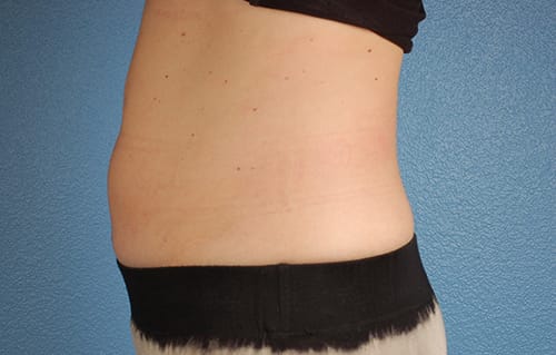CoolSculpting Before & After Gallery - Patient 126163 - Image 4