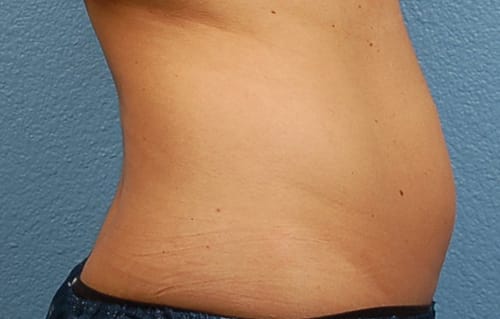 CoolSculpting Before & After Gallery - Patient 126163 - Image 5