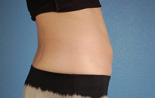 CoolSculpting Before & After Gallery - Patient 126163 - Image 6