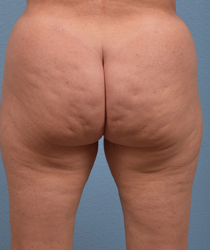 Cellfina Before & After Gallery - Patient 323970 - Image 1