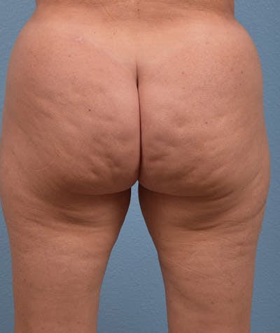 Cellfina Before & After Gallery - Patient 323970 - Image 1