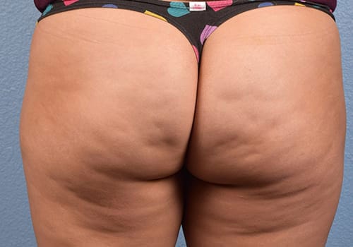 Cellfina Before & After Gallery - Patient 410032 - Image 1