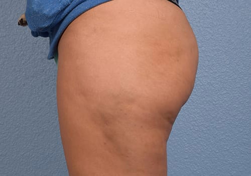 Cellfina Before & After Gallery - Patient 410032 - Image 4