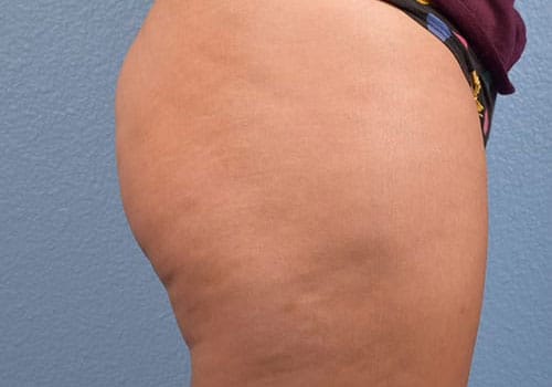 Cellfina Before & After Gallery - Patient 410032 - Image 5