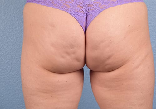 Cellfina Before & After Gallery - Patient 410576 - Image 1