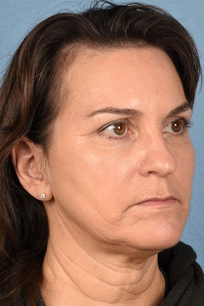Liposuction Before & After Gallery - Patient 856959 - Image 1