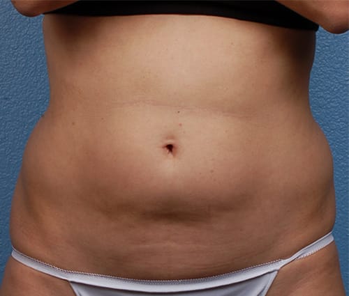 Hidden Patients Before & After Gallery - Patient 162999 - Image 1