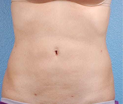 Hidden Patients Before & After Gallery - Patient 162999 - Image 2