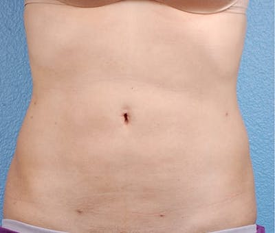 Liposuction Before & After Gallery - Patient 755337 - Image 2