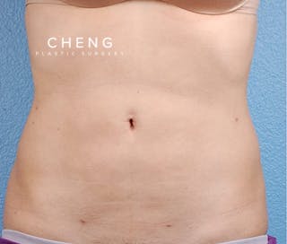 Hidden Patients Before & After Gallery - Patient 162999 - Image 2