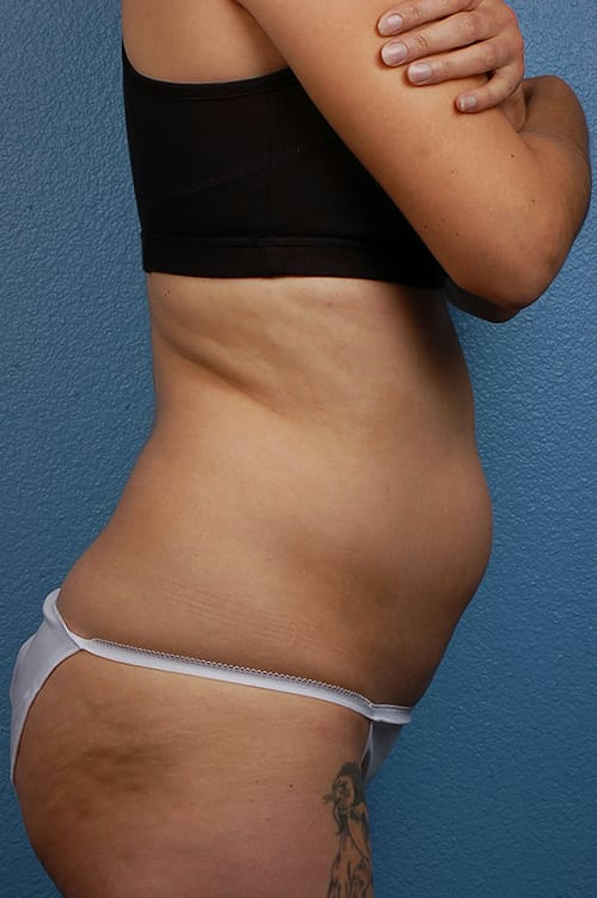 Liposuction Before & After Gallery - Patient 755337 - Image 5