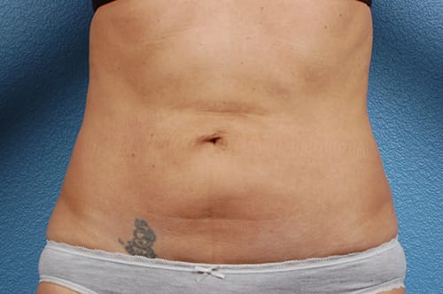 Liposuction Before & After Gallery - Patient 290094 - Image 1