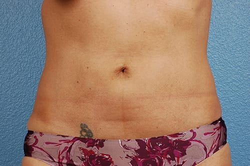 Liposuction Before & After Gallery - Patient 290094 - Image 2