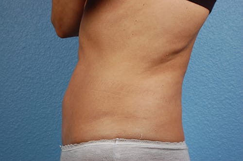 Liposuction Before & After Gallery - Patient 290094 - Image 3