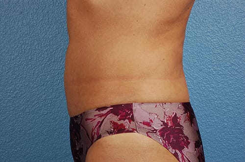 Liposuction Before & After Gallery - Patient 290094 - Image 4